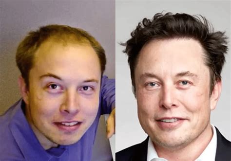 Beroemde Persoonlijkheden Die Haartransplantatie Hebben Ondergaan