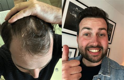 Haartransplantatie Voor En Na: De Impact Op Zelfvertrouwen