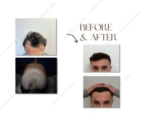 Wat Te Verwachten Tijdens Een Haartransplantatie DHI